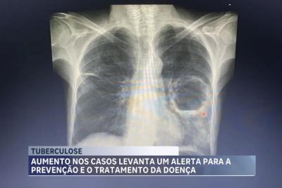 Tuberculose: 1º trimestre de 2024 registra 325 casos e 35 mortes da doença